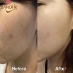 نتایج استفاده از سرم ضد لک اکسیس وای