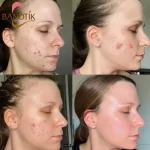 نتیجه ی استفاده از کرم دور چشم بیوتی آف چوسان