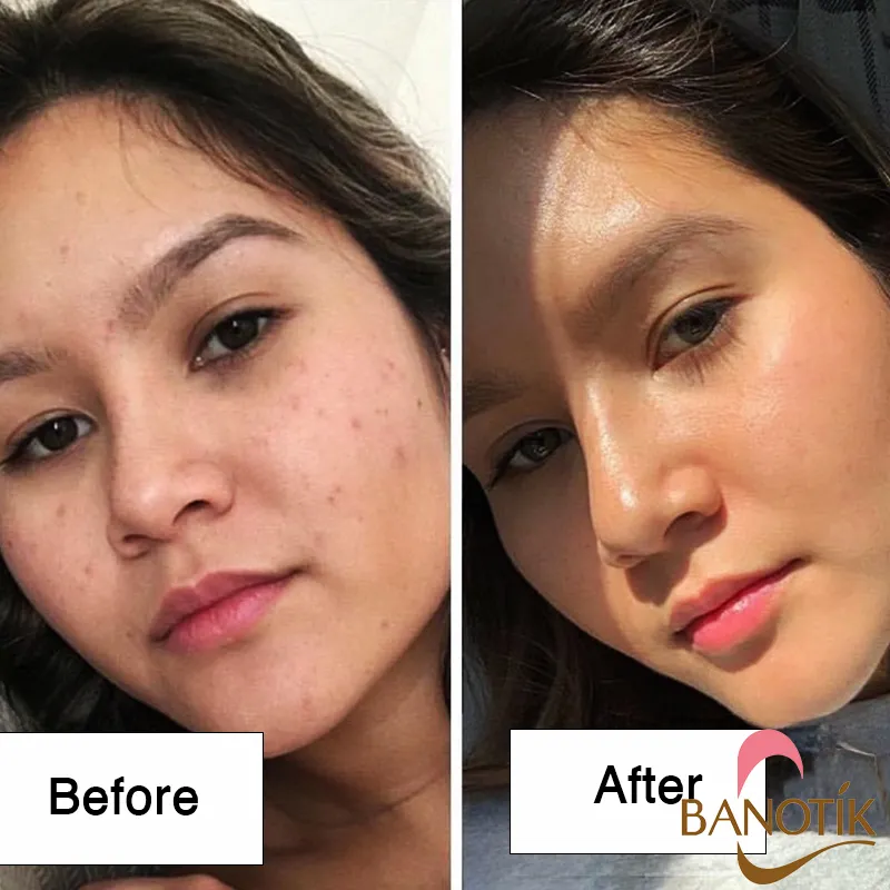 نتایج استفاده از ضد آفتاب بایودرما اسپات ایج