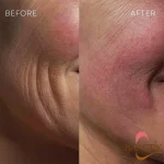 نتایج استفاده بوستر کوزارکس