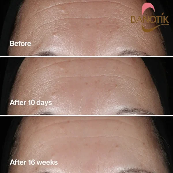 نتایج استفاده از سرم ضد چروک اسمارت کلینیک