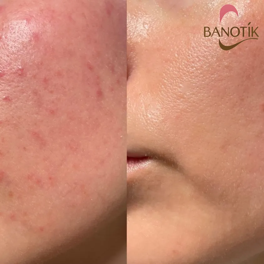 مقایسه قبل و بعد استفاده از ژل شستشوی سراوی برای پوست جوشدار