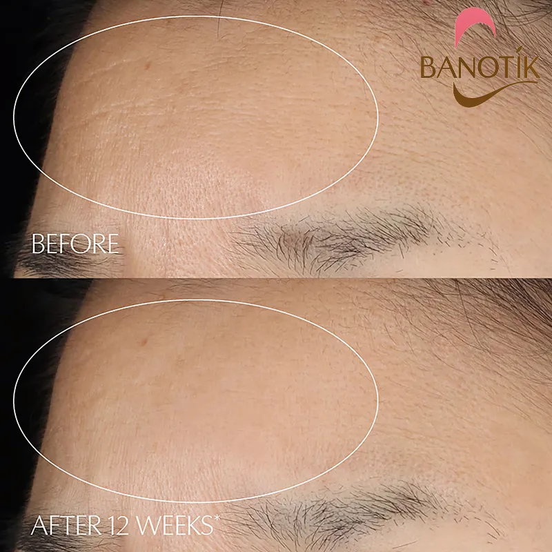 نتیجه ی استفاده از سرم رتینول لاروش پوزای