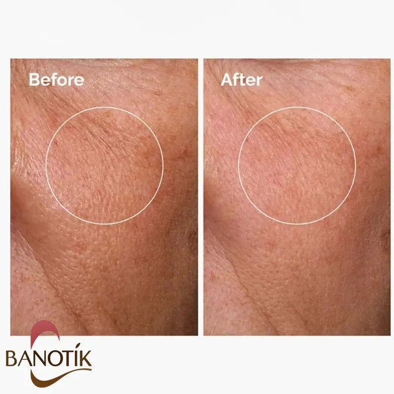 نتایج استفاده از سرم هیالورونیک اسید اوردینری 30ml