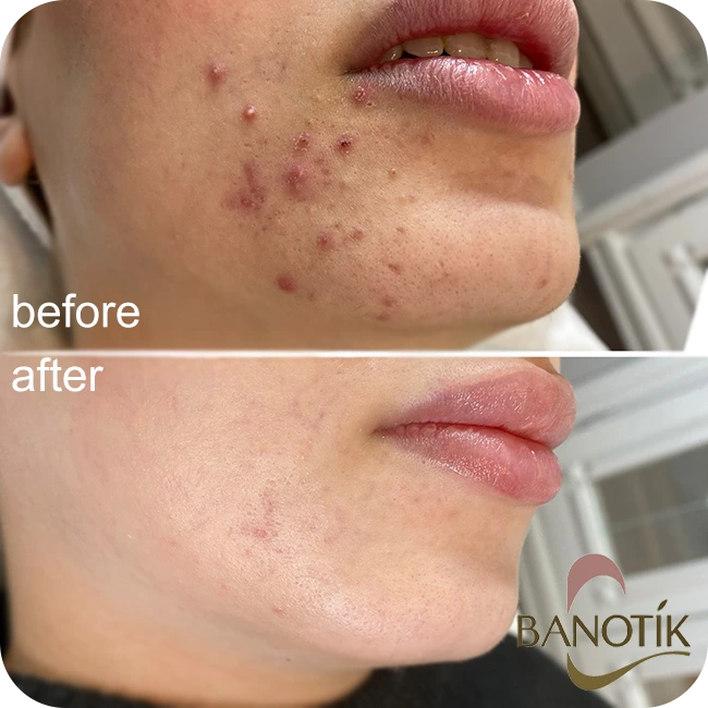 نحوه استفاده از سرم سالیسیلیک اسید اوردینری در روتین پوستی