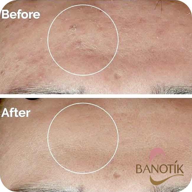 تغییرات و نظرات کاربران در مورد سرم نیاسینامید اوردینری قبل و بعد استفاده